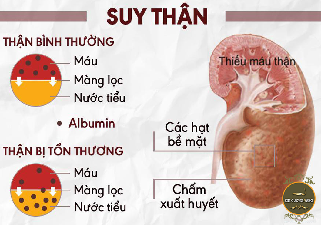 Dấu hiệu cảnh b1o suy thận ở nàm và nữ