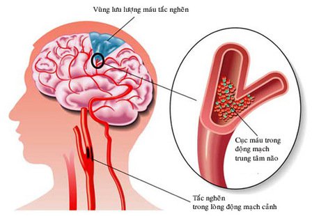 đột quỵ là gì